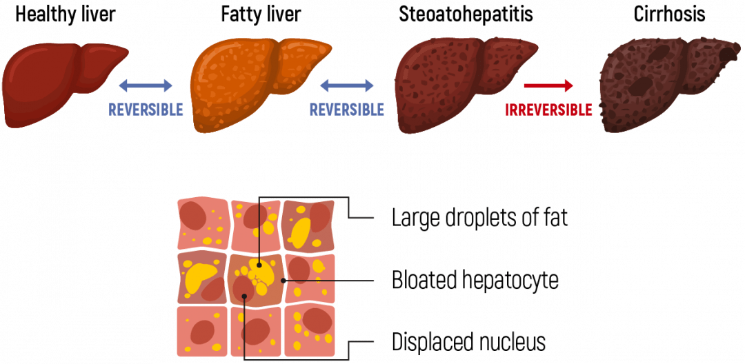 Hepastrong AMINO protects liver from fat accumulation. Ornithine cleans liver from toxic ammonia. Lowers ALT, AST. Prevents inflammation.